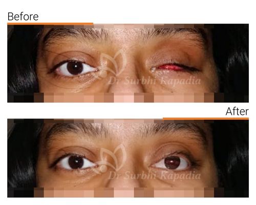 Artificial Eye (Ocular Prosthetic Eye )