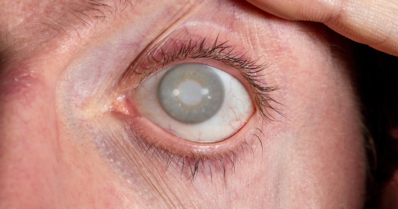Cataract-Surgery