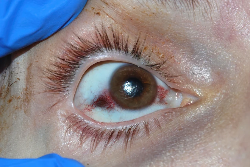 Pterygium-વેલ-Surgery-min